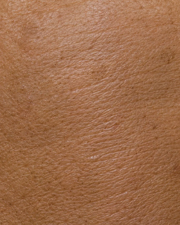 Aging Skin