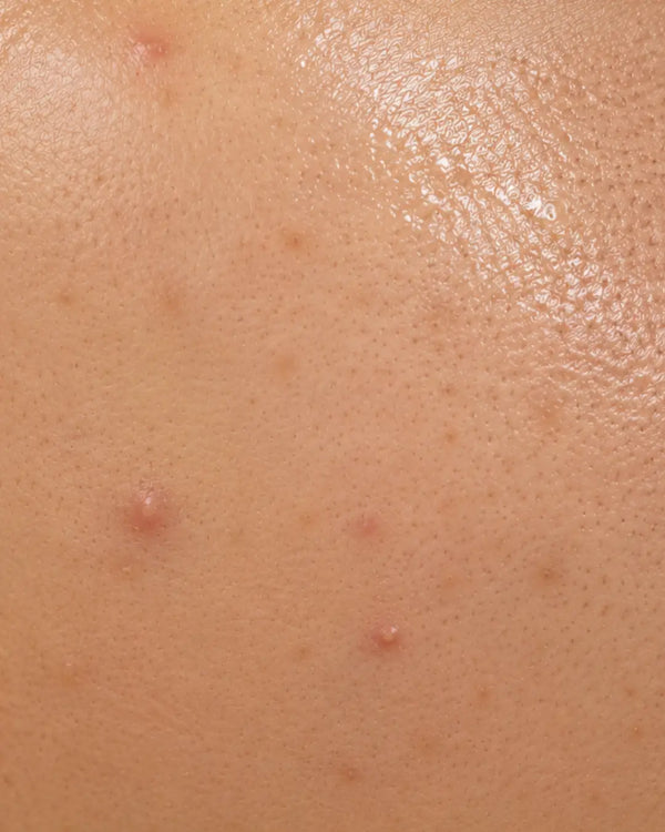 Combination Skin