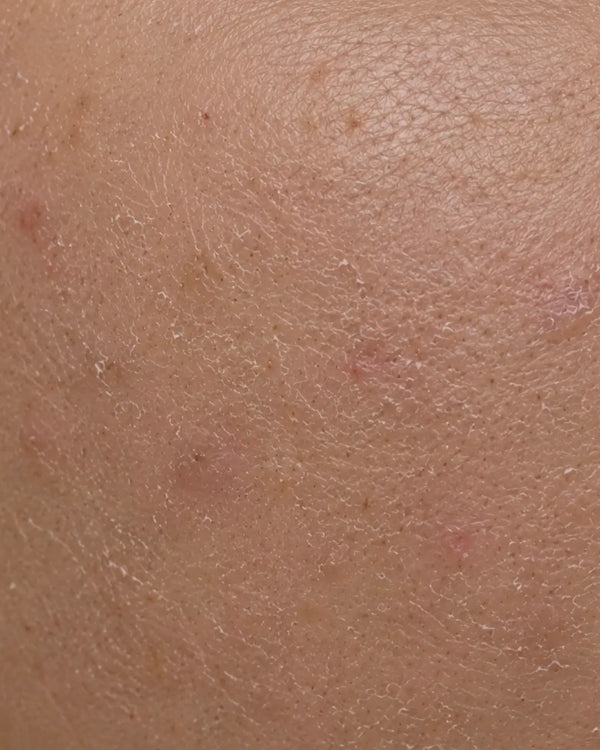 Damaged / Stressed Skin
