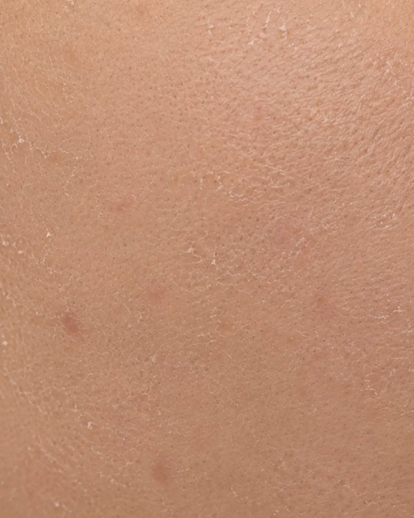 Dry Skin