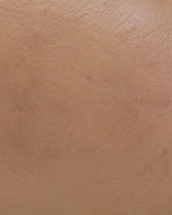 Dull & Tired Skin