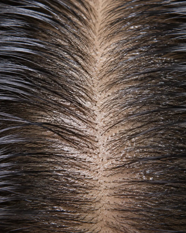 Oily Scalp