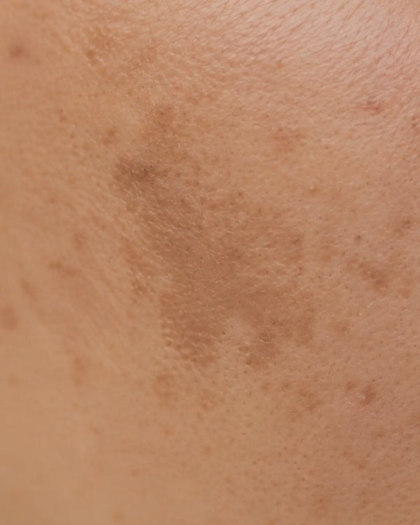 Pigmentation / Uneven Skin